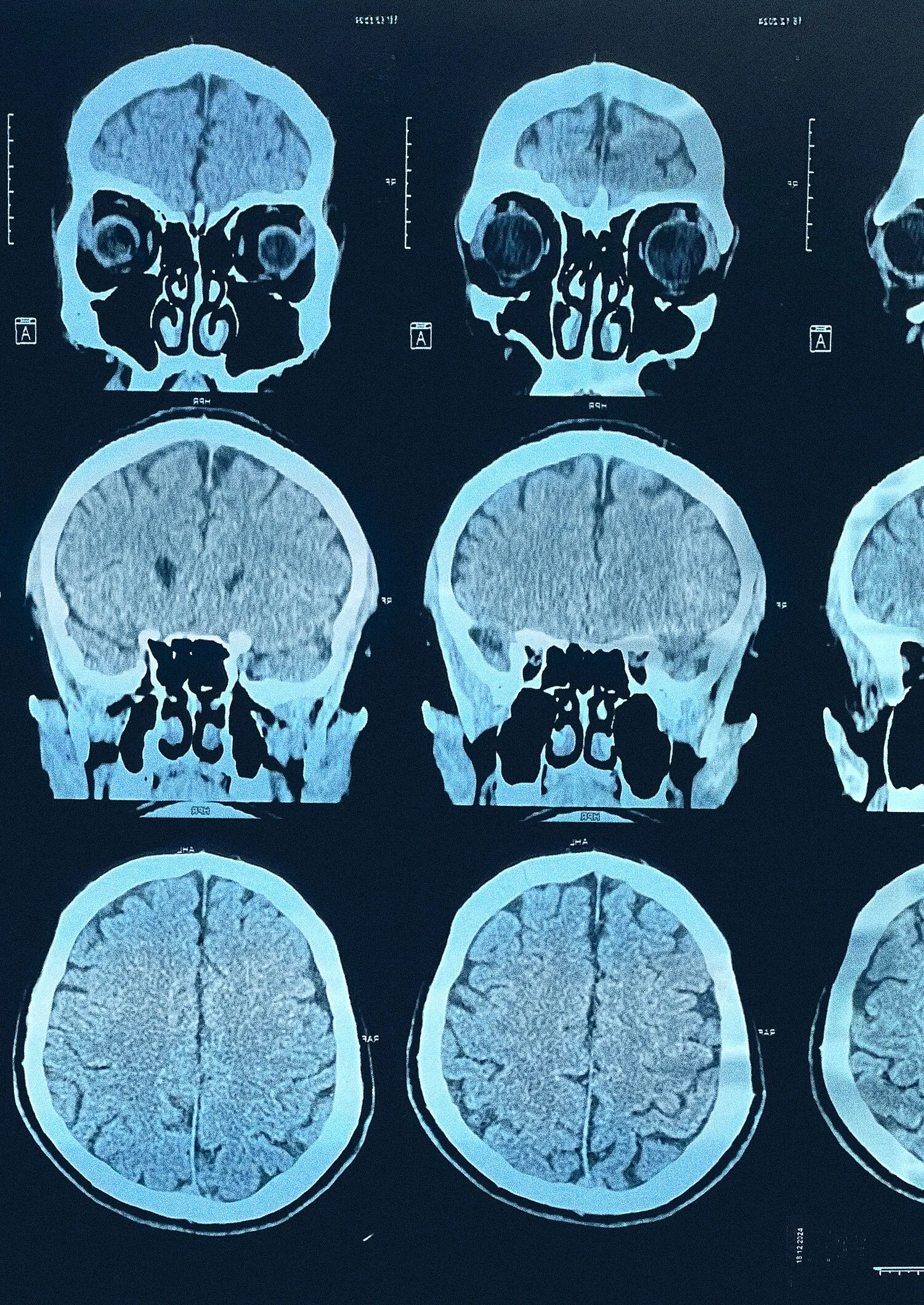 Tomografía del cerebro de Alvi